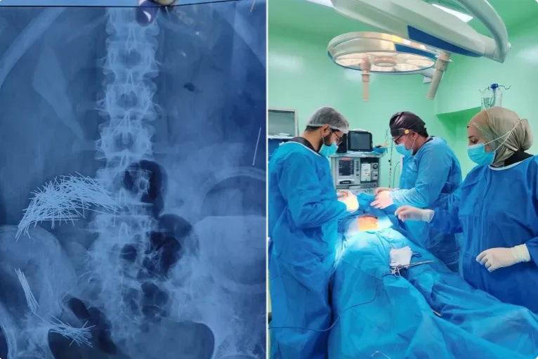 استخراج 214 إبرة ودبوسا من بطن رجل في العراق